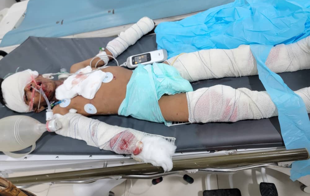 طفل اصيب نتيجة انفجار مقذوف من مخلفات الحرب في مأرب طفل اصيب نتيجة انفجار مقذوف من مخلفات الحرب في مأرب